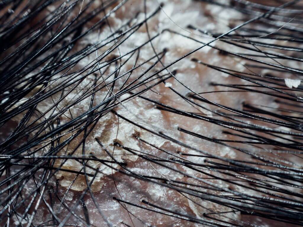 Seborrheas dermatitis fejbőr