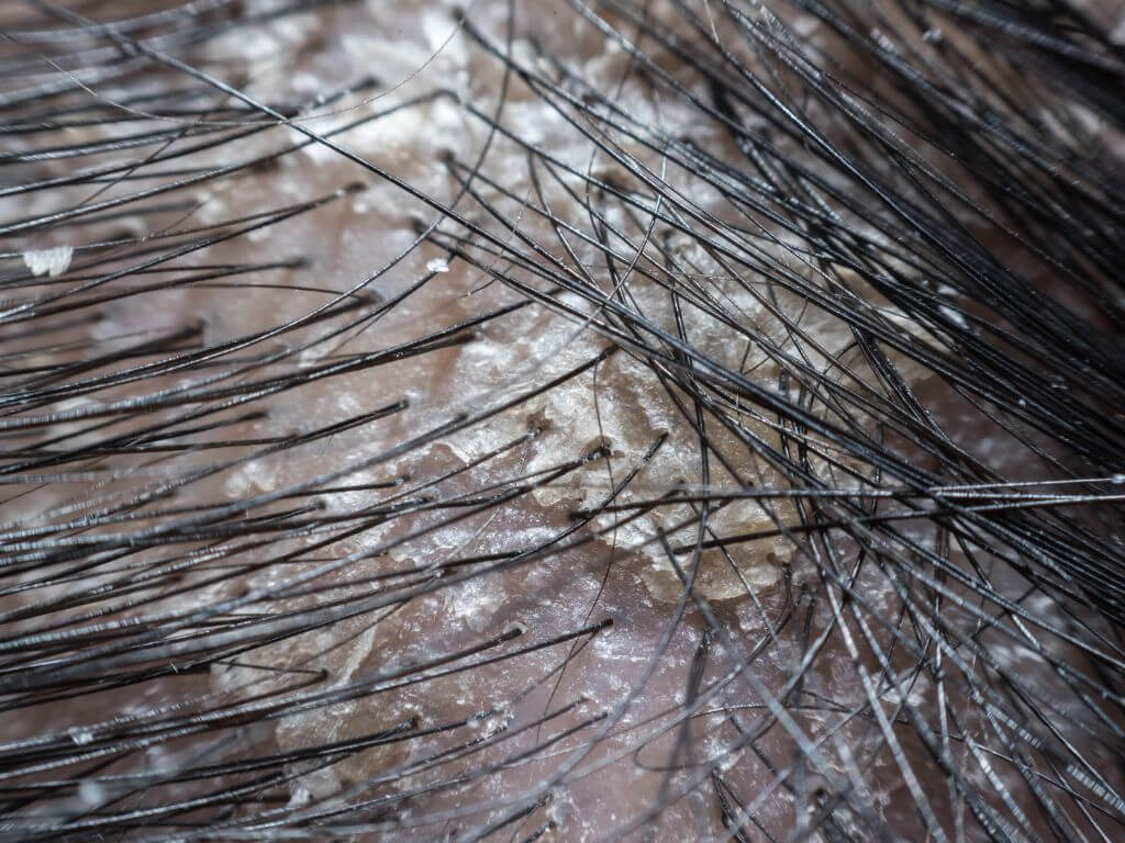 Seborrheas dermatitis fejbőr