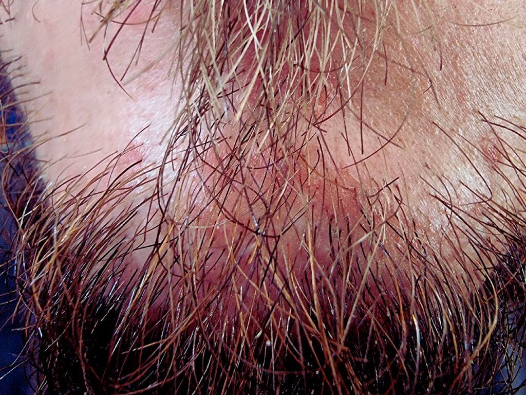 Seborrheas dermatitis bőrtünet